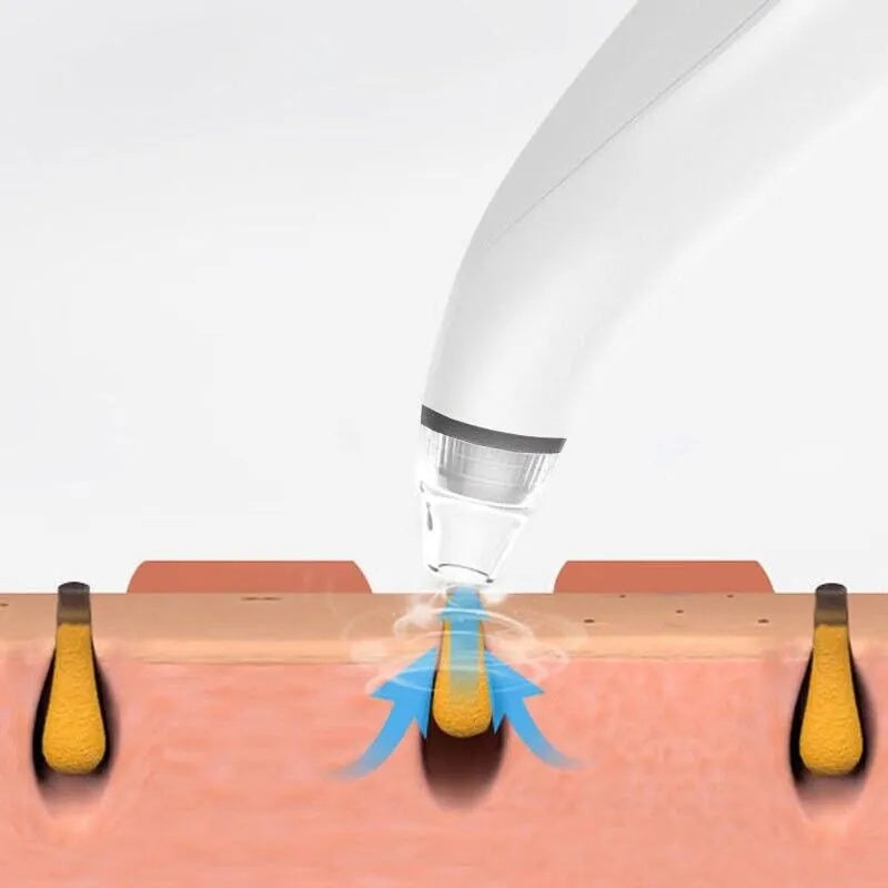 Illustration of a Electric Blackhead Remover doing a suction removing a blackhead
